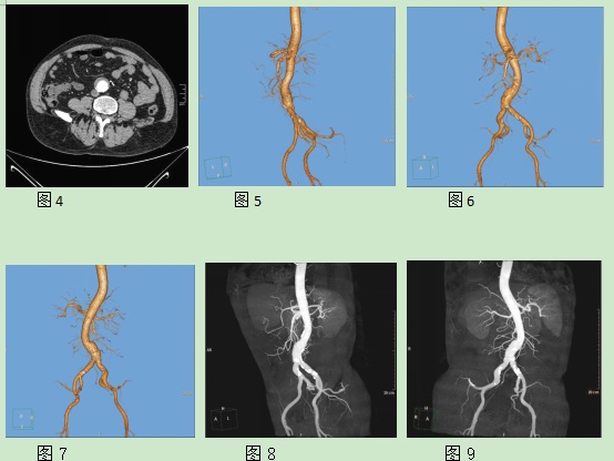 医学影像论文-多层CT扫描及VR重建技术在腹主动脉下段动脉瘤中应用